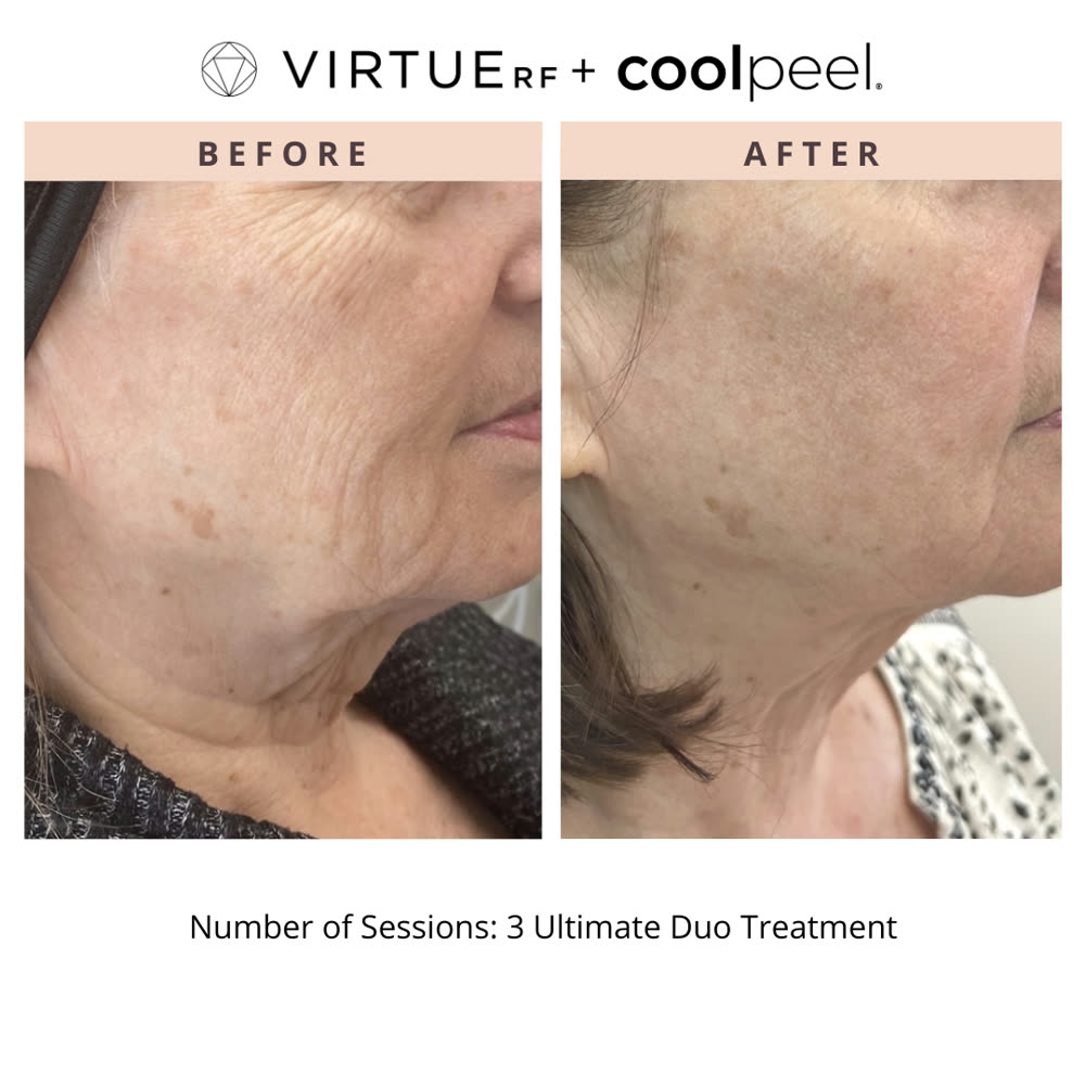 VirtueRF + CoolPeel before and after