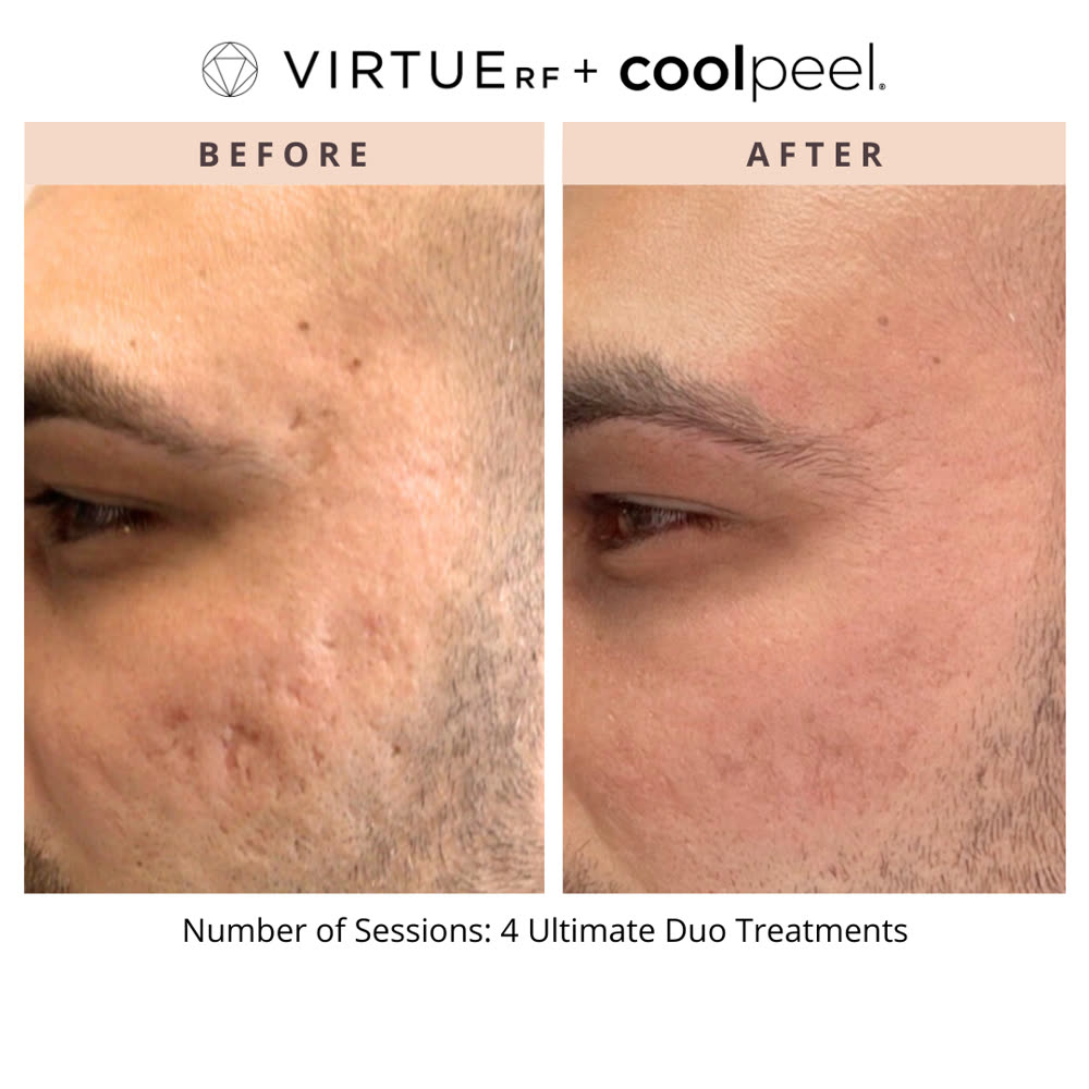 VirtueRF + CoolPeel before and after