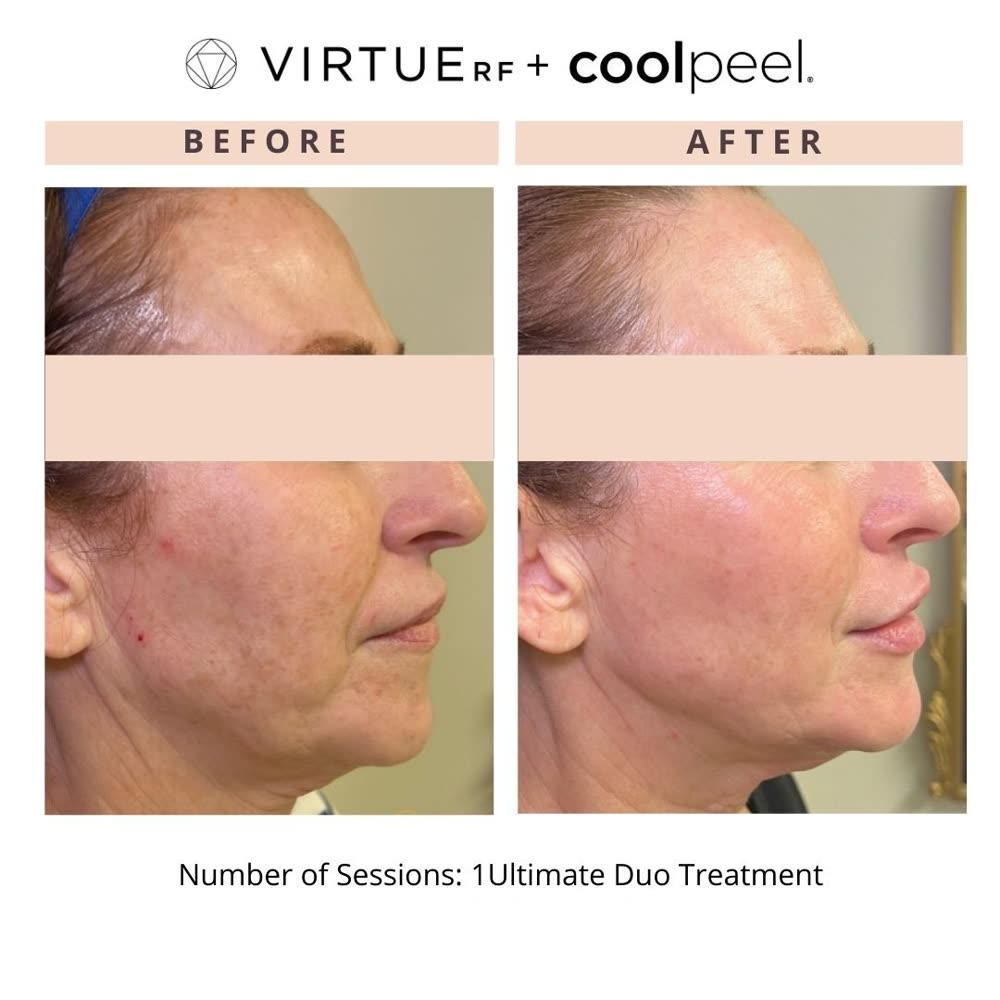 VirtueRF + CoolPeel before and after