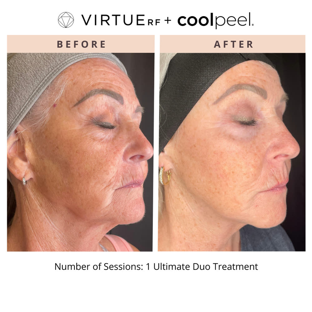 VirtueRF + CoolPeel before and after