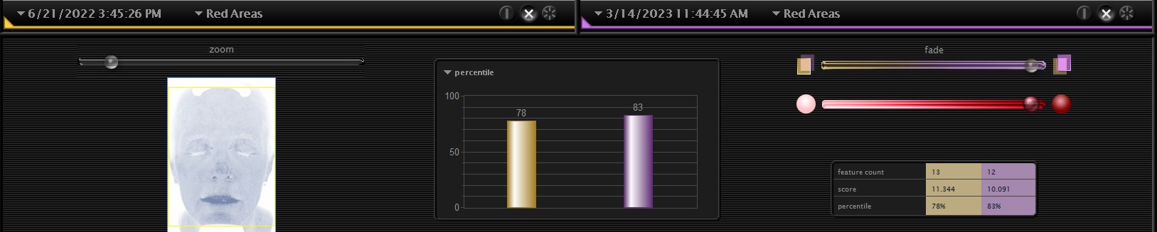 The Visia comparison panel for Carroll's Red Areas view: both image dates, the percentile chart rising from 78 to 83, and the table of feature count, score, and percentile
