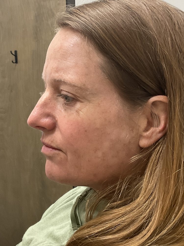 Left side of Bret's face two weeks after one Elluminate session, clinical photo