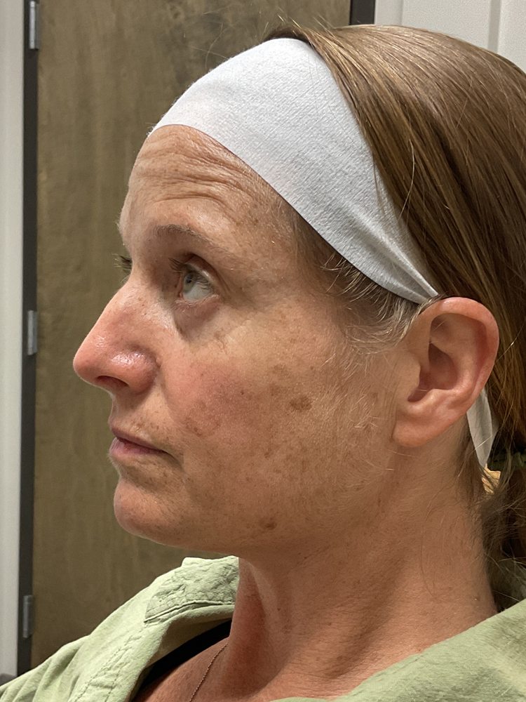 Left side of Bret's face before Elluminate, clinical photo