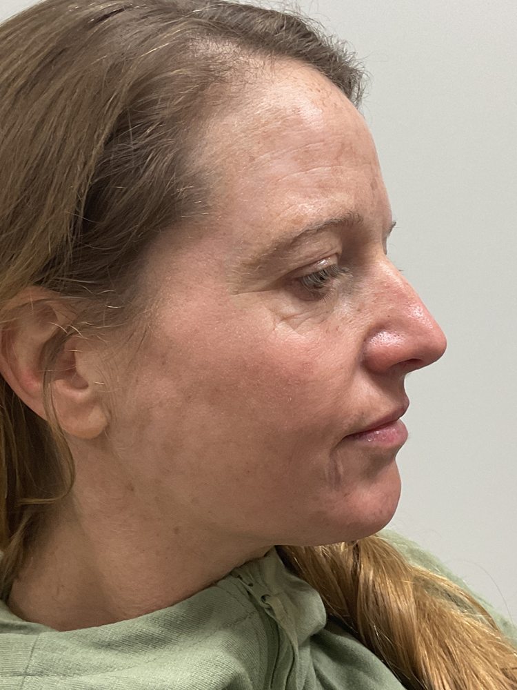 Right side of Bret's face two weeks after one Elluminate session, clinical photo