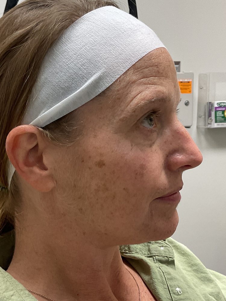 Right side of Bret's face before Elluminate, clinical photo