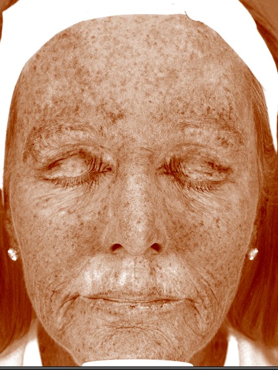 Carroll in the Visia Brown Spots view nine months later