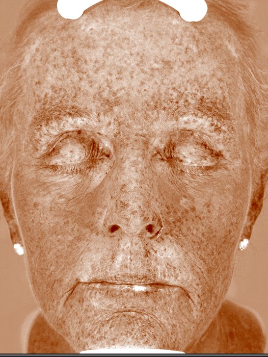 Carroll in the Visia Brown Spots view before treatment