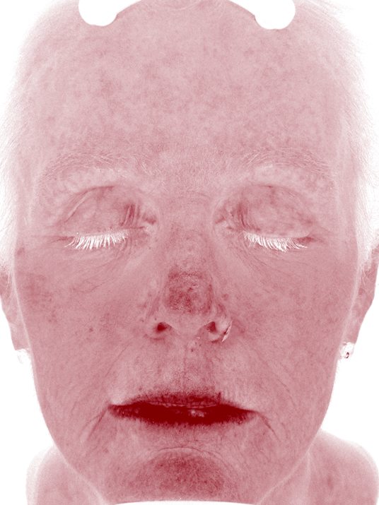 Carroll in the Visia Red Areas view before treatment