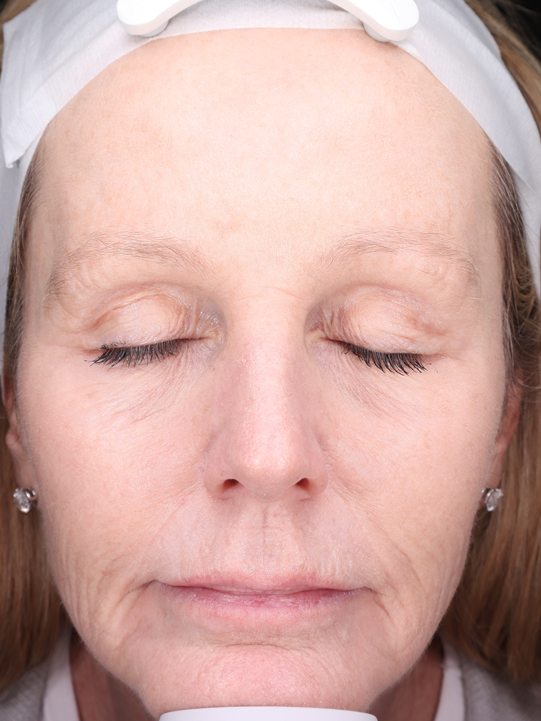 Carroll's face nine months later after two VirtueRF sessions and filler, Visia standard photo