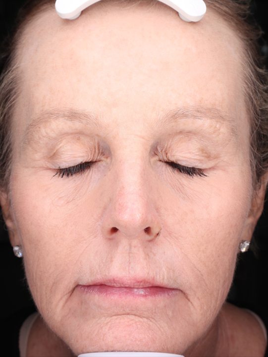 Carroll's face before treatment, Visia standard photo