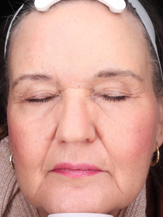 Cindi's face five months later, Visia standard photo