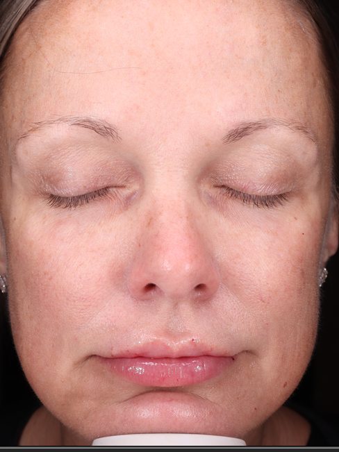 Courtney's face 27 months later, Visia standard photo
