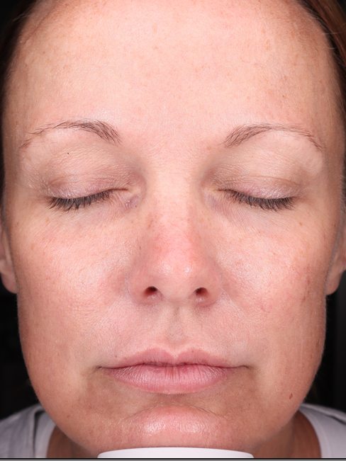 Courtney's face before lip filler, Visia standard photo