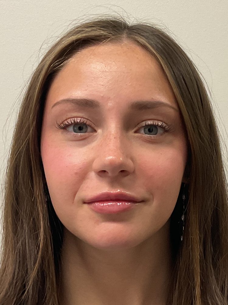 Grace's face and lips right after lip filler, clinical photo