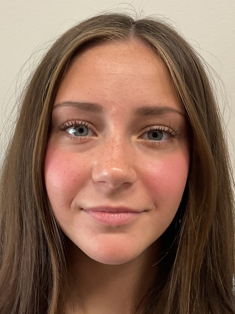 Grace's face and lips before lip filler, clinical photo