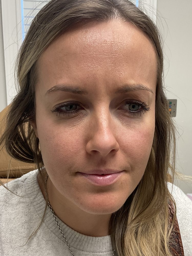 Jessica frowning two weeks after Xeomin and Dysport, clinical photo