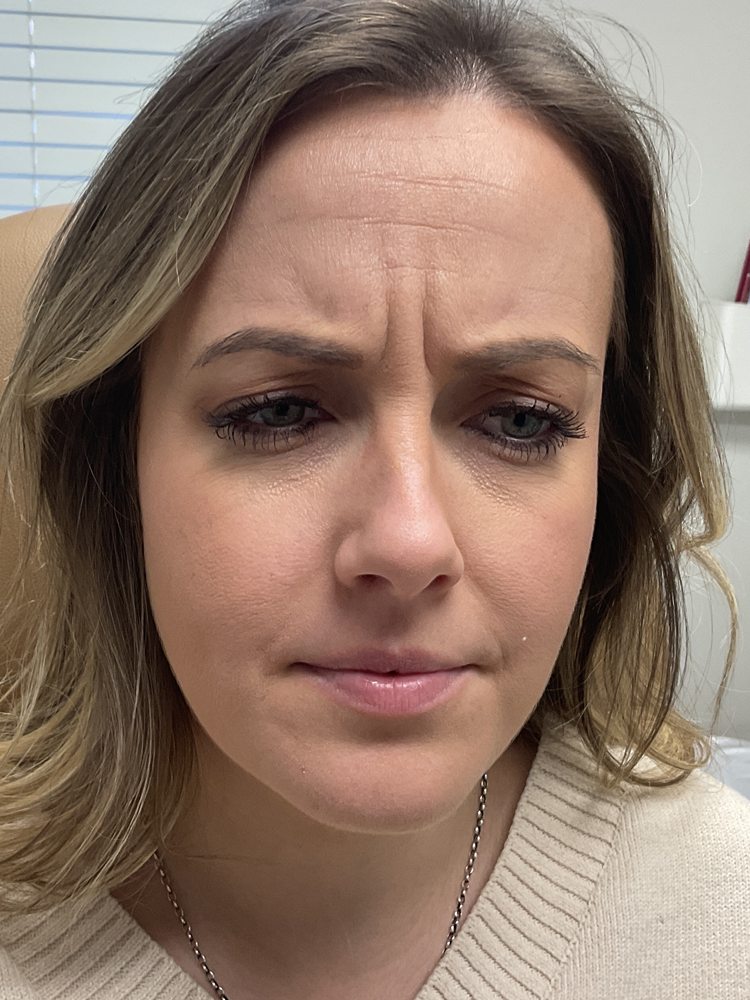 Jessica frowning before Xeomin and Dysport, clinical photo