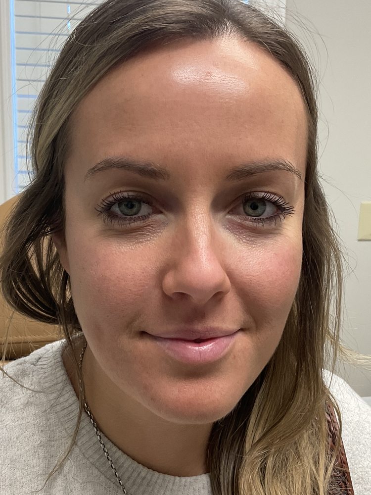 Jessica with a relaxed expression two weeks after Xeomin and Dysport, clinical photo