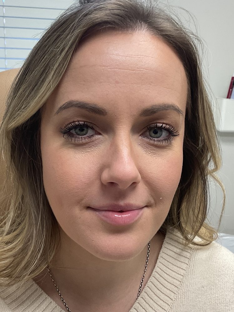 Jessica with a relaxed expression before Xeomin and Dysport, clinical photo
