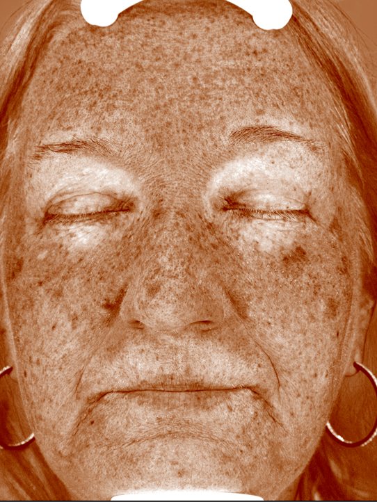 Karen in the Visia Brown Spots view four months later