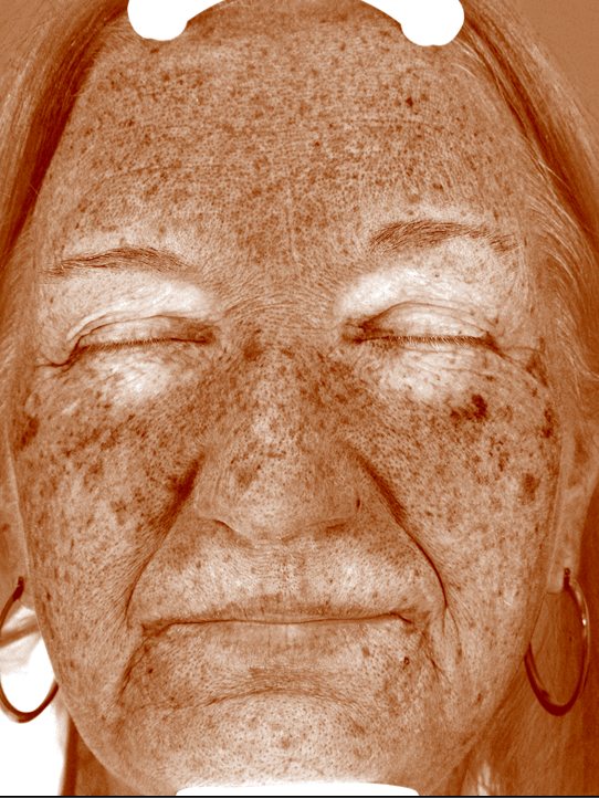 Karen in the Visia Brown Spots view before three Elluminate sessions