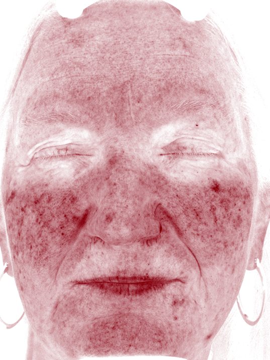 Karen in the Visia Red Areas view before three Elluminate sessions