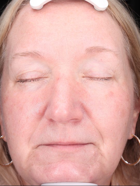 Karen's face four months later, Visia standard photo