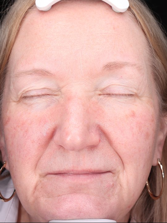 Karen's face before three Elluminate sessions, Visia standard photo