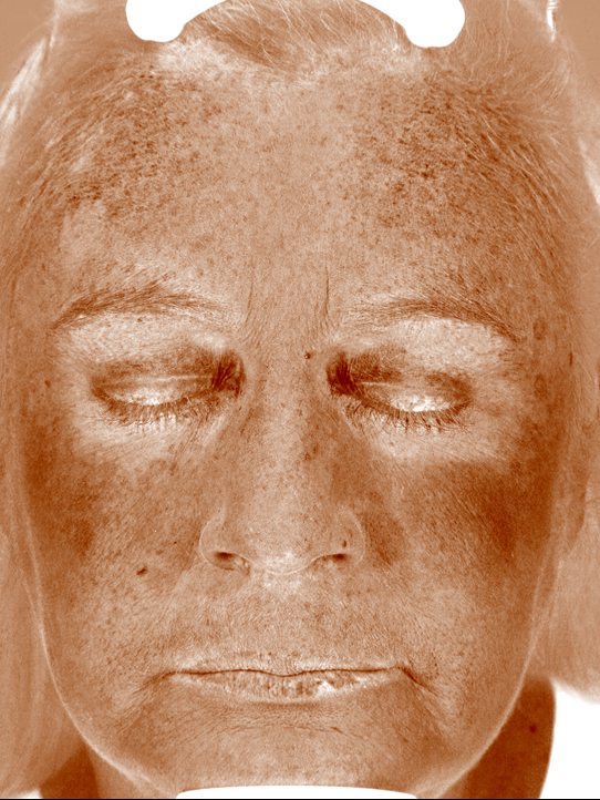 Keri in the Visia Brown Spots view two weeks later