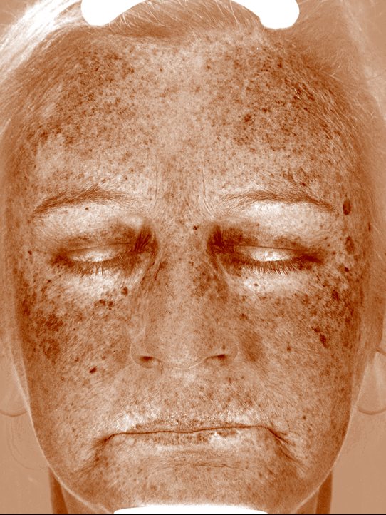 Keri in the Visia Brown Spots view before a VI Peel and wrinkle relaxers