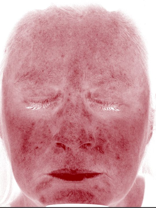 Keri in the Visia Red Areas view two weeks later