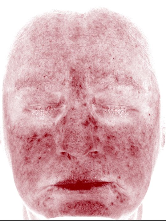 Keri in the Visia Red Areas view before a VI Peel and wrinkle relaxers