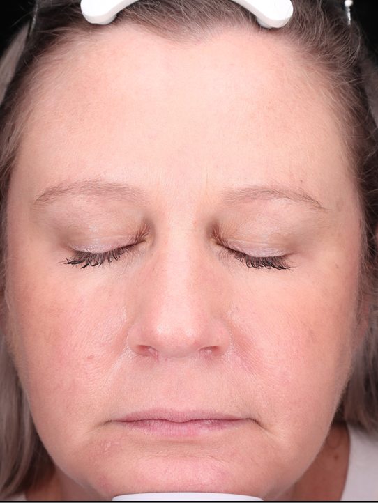 Keri's face two weeks later, Visia standard photo