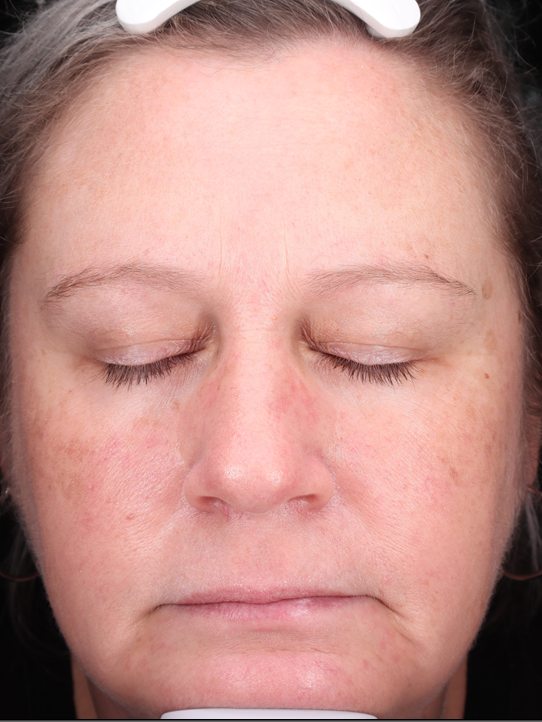 Keri's face before a VI Peel and wrinkle relaxers, Visia standard photo