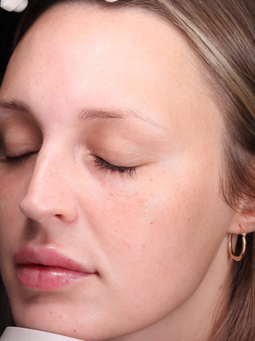 Knavie's left profile after her plan, Visia standard photo