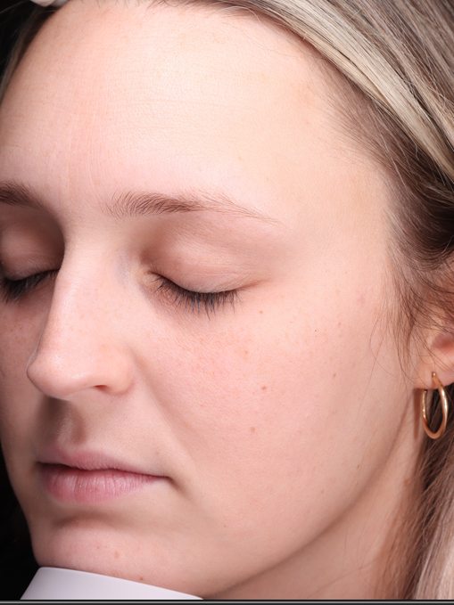 Knavie's left profile at her first consultation, Visia standard photo
