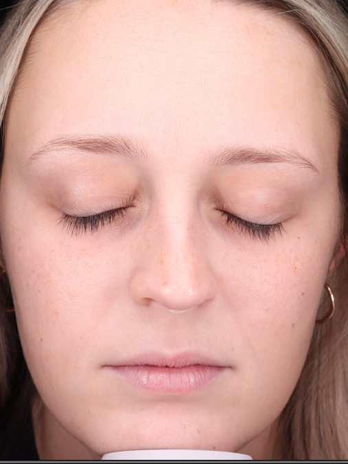 Knavie's face at her first consultation, Visia standard photo