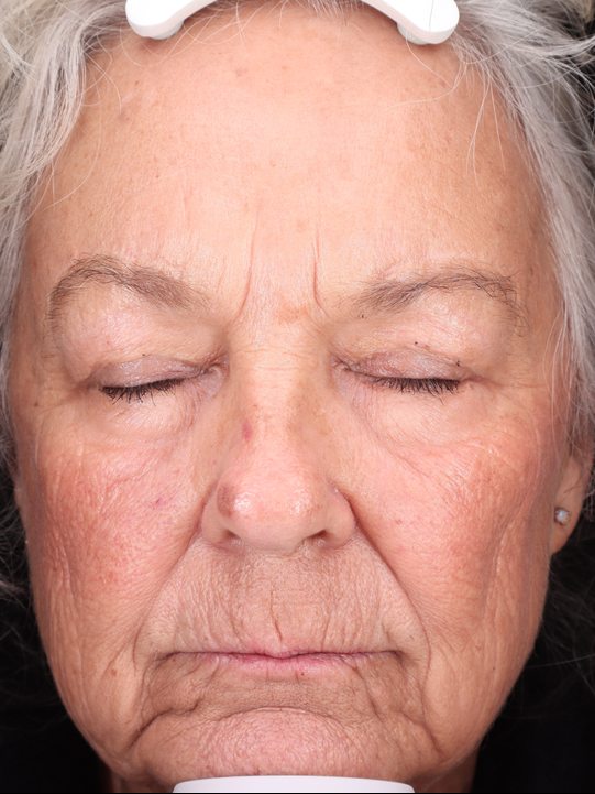 Linda's face six months later, Visia standard photo