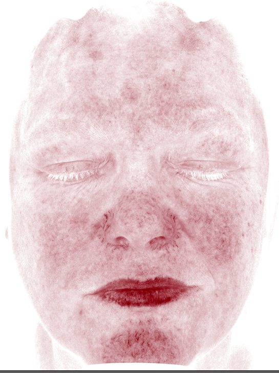 Michelle in the Visia Red Areas view after her plan