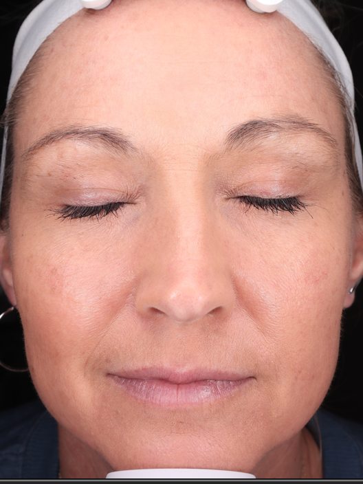 Nikole's face before VirtueRF, Botox, and filler, Visia standard photo