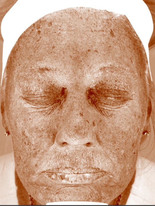 Pamela in the Visia Brown Spots view before three years of VirtueRF, CoolPeel and more