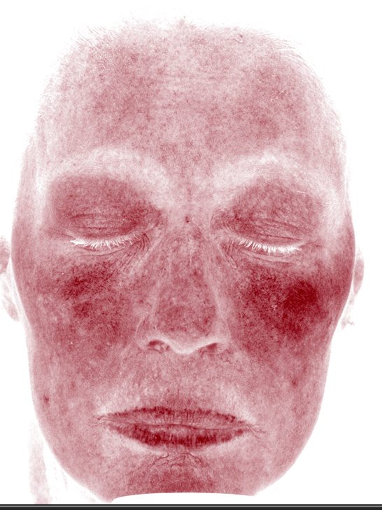 Pamela in the Visia Red Areas view three years later