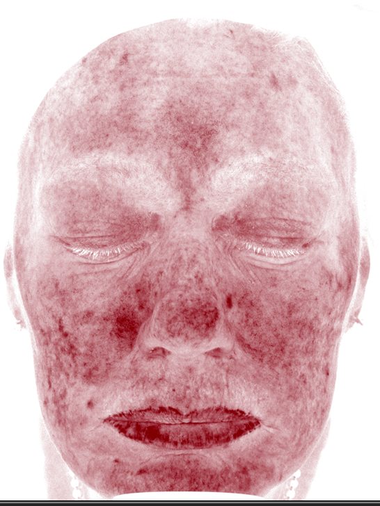 Pamela in the Visia Red Areas view before three years of VirtueRF, CoolPeel and more