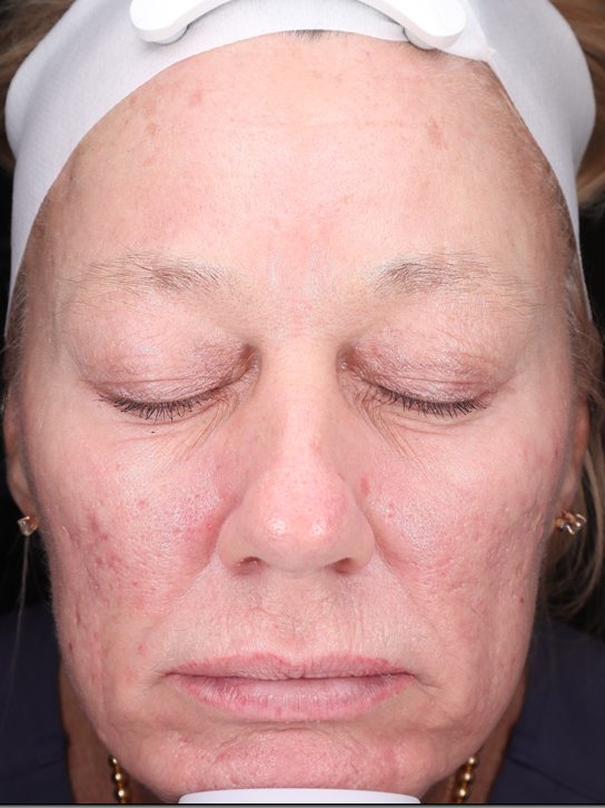 Pamela's face before three years of VirtueRF, CoolPeel and more, Visia standard photo