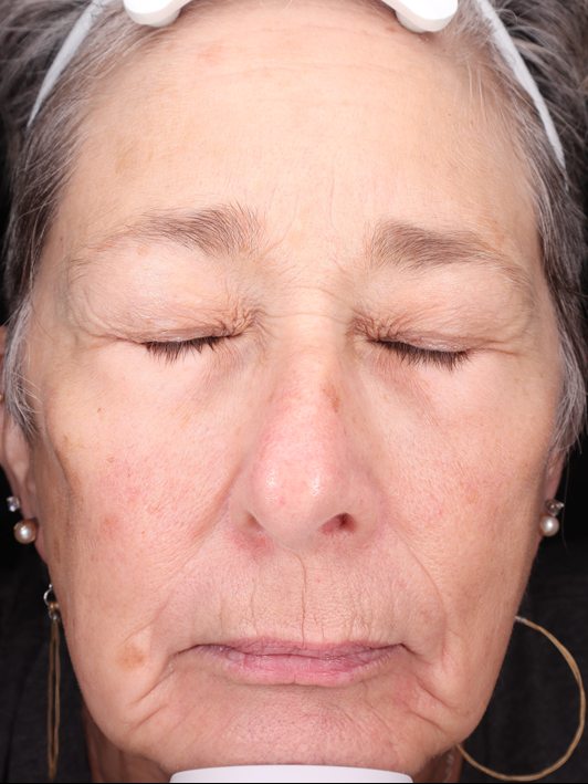 Pamela's face six months later, Visia standard photo