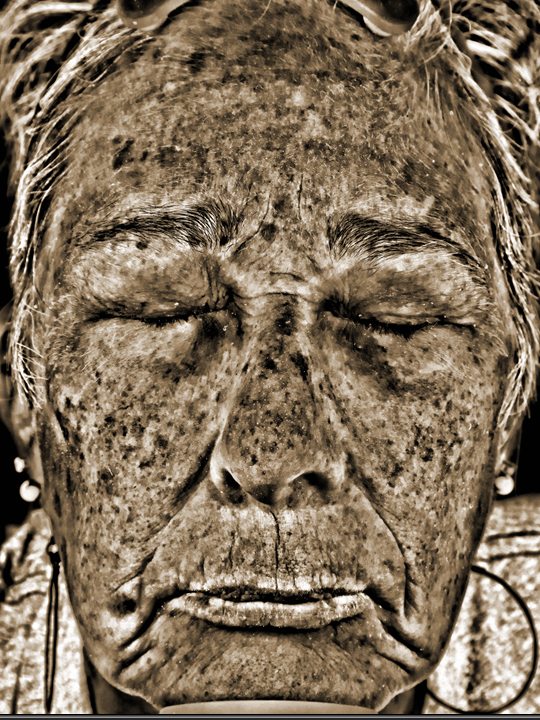 Pamela in the Visia UV Spots view six months later