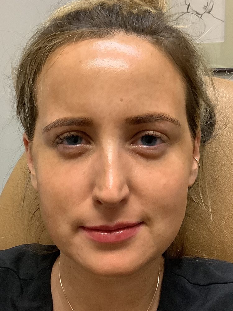 Rachel frowning two weeks after Dysport, clinical photo