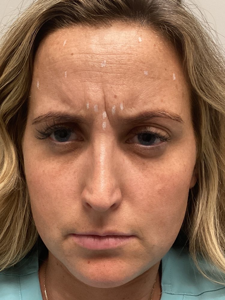 Rachel frowning before Dysport, clinical photo