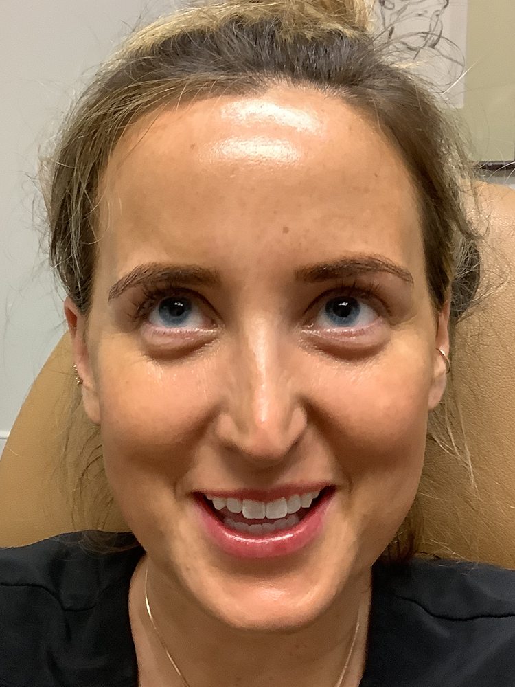 Rachel raising her brows two weeks after Dysport, clinical photo