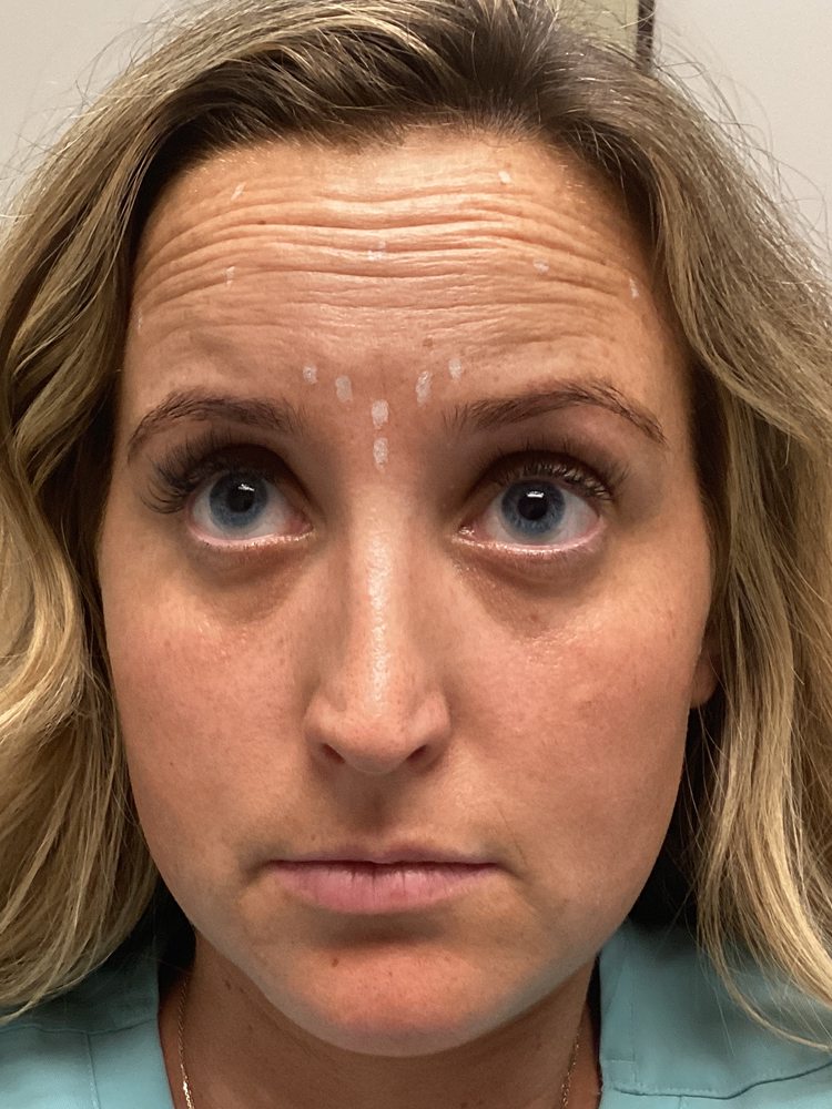 Rachel raising her brows before Dysport, clinical photo